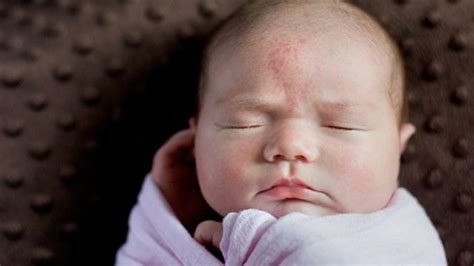 A Parent's Quick Guide to Birthmarks .